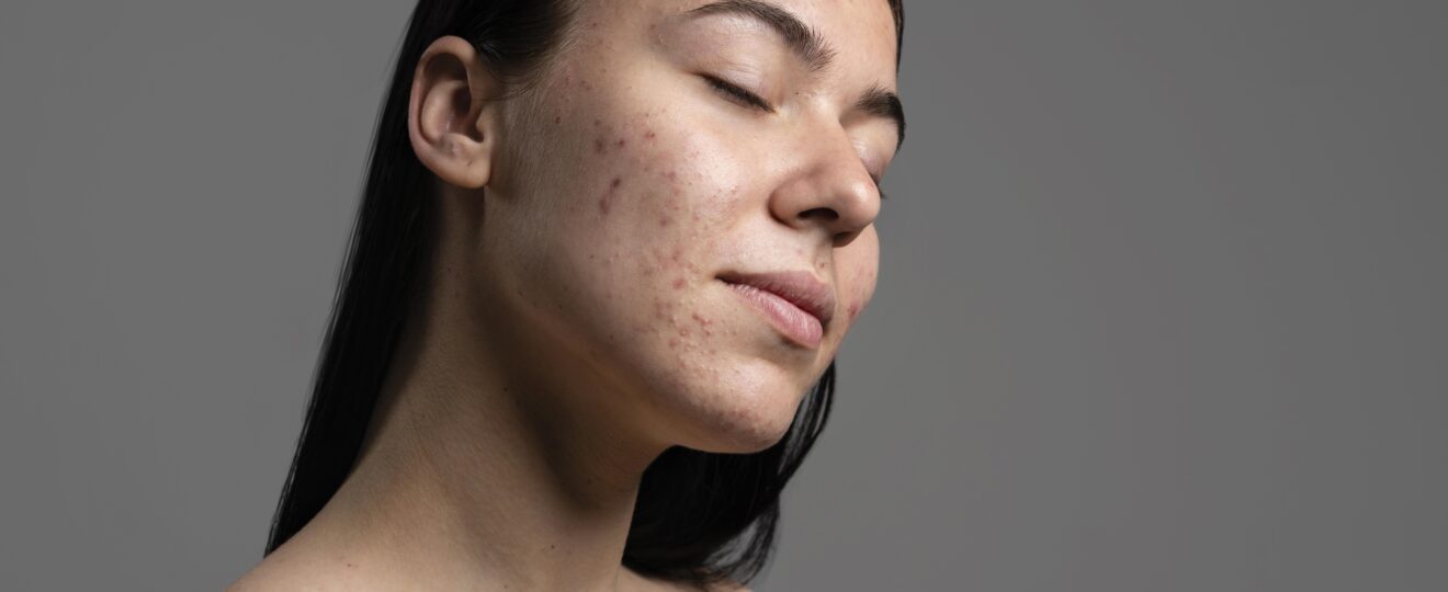 korean toners for acne