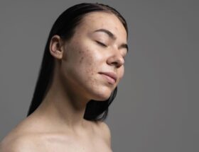 korean toners for acne